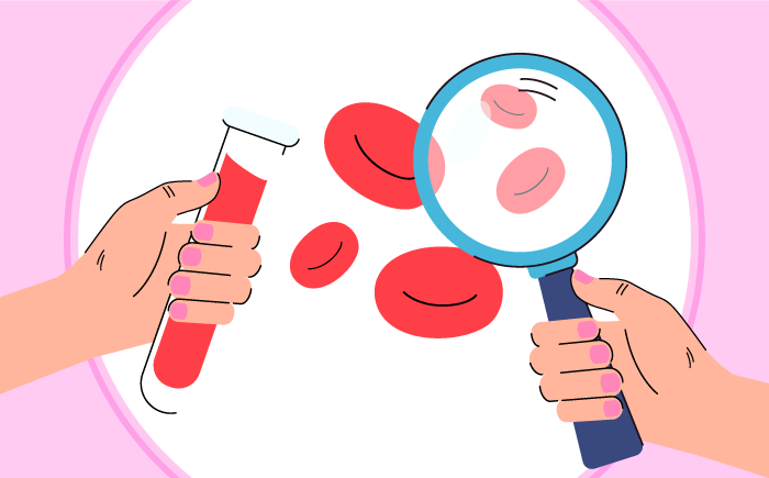 Diagram comparing healthy round red blood cells to sickle-shaped cells that block blood flow, the cause of pregnancy complications in sickle cell disease.
