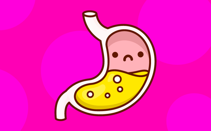 Diagram of the esophagus and stomach in a preemie, showing how weak muscles cause acid reflux and Gastroesophageal Reflux Disease (GERD).